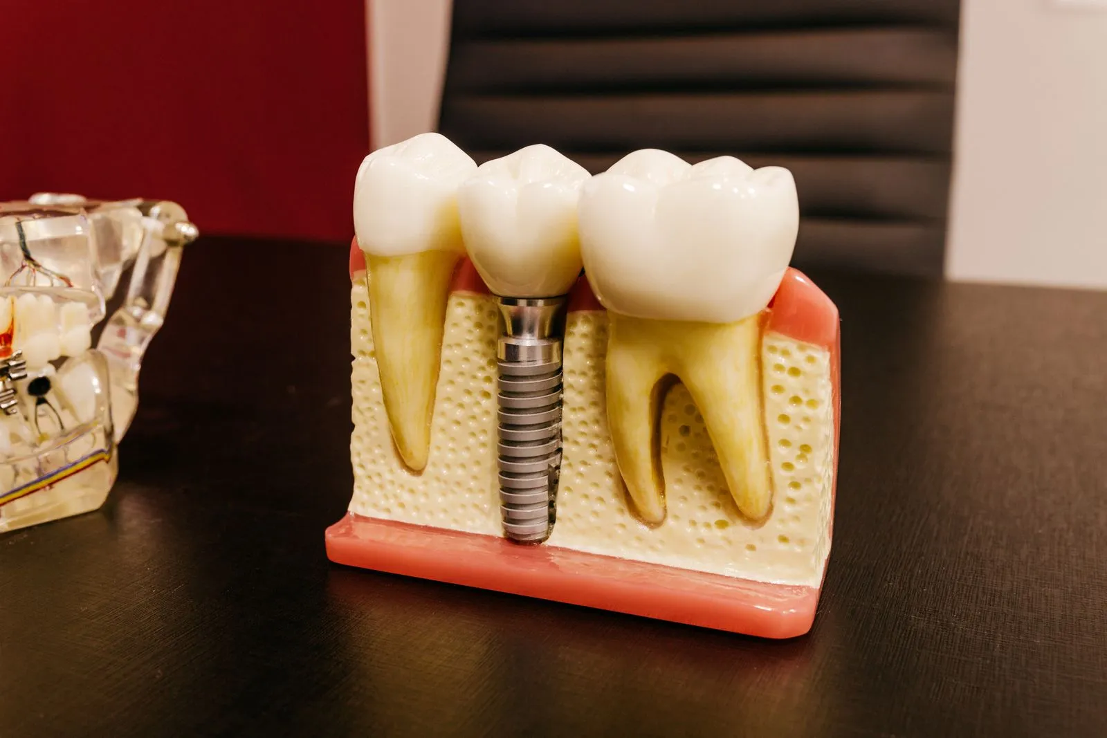 Modelo dental que muestra un implante de titanio entre dos piezas naturales